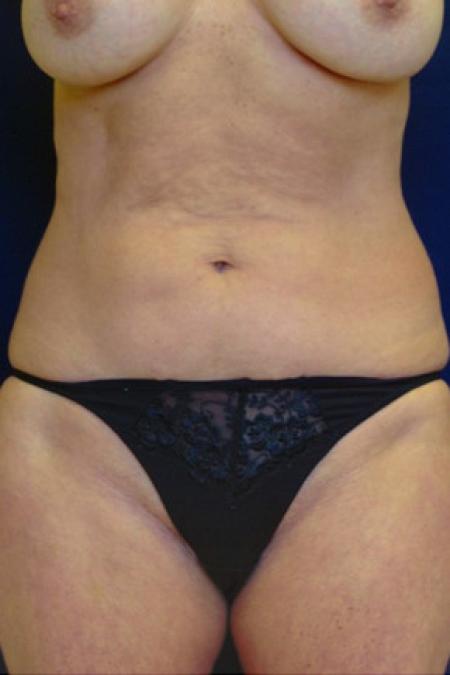 Before image 1 Case #102936 - Abdominoplasty