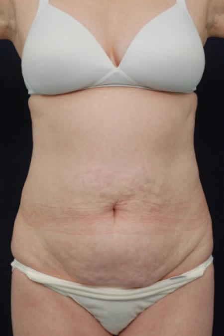 Before image 1 Case #102841 - Abdominoplasty