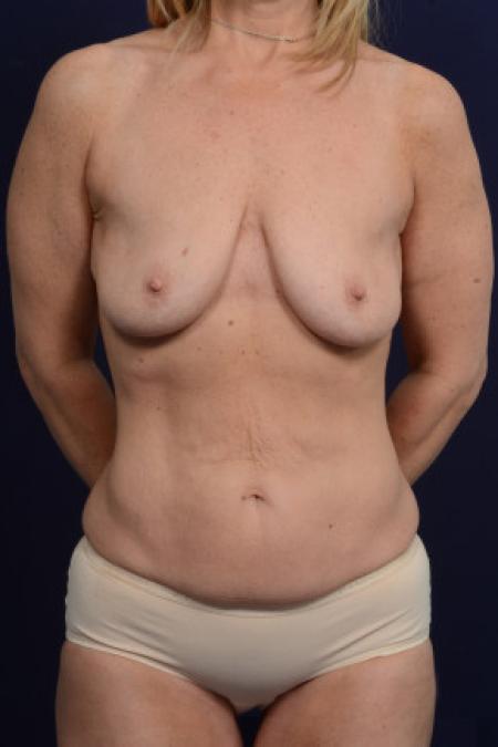 Before image 1 Case #102766 - Mommy Makeover