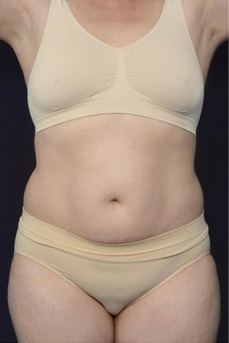 Before image 1 Case #102546 - Liposuction