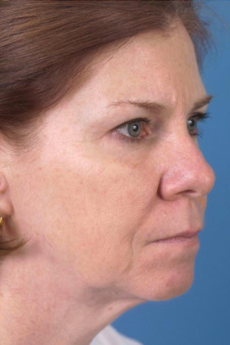 Before image 2 Case #102146 - Facelift - 57-year-old woman