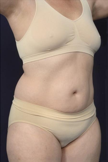 Before image 2 Case #102546 - Liposuction