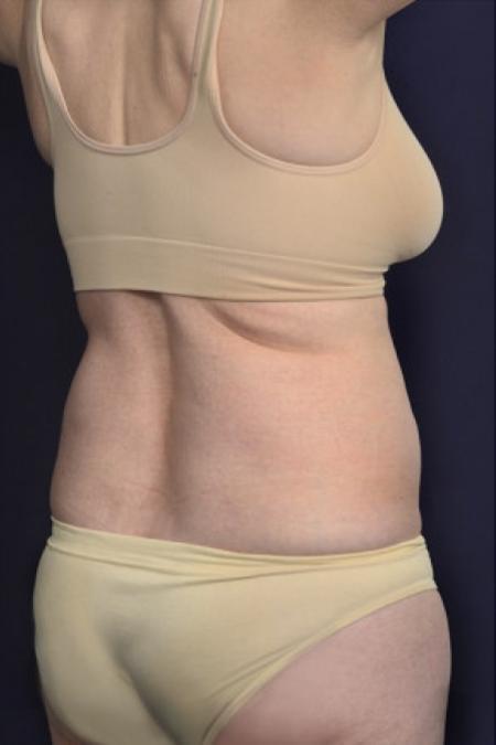 Before image 2 Case #102486 - Liposuction