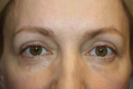 After image 1 Case #85046 - Blepharoplasty - Upper Lids Only - 46 year old female