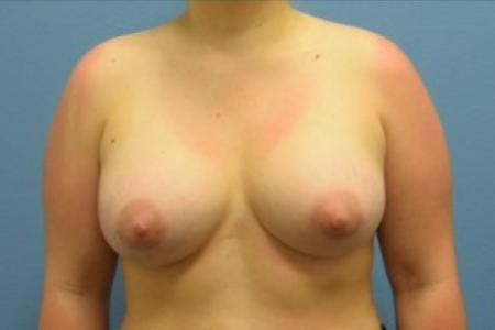 After image 1 Case #86166 - Breast Augmentation with Silicone Implants