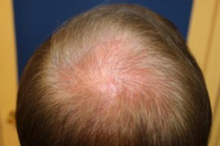 After Case #87386 - Hair Transplantation San Diego