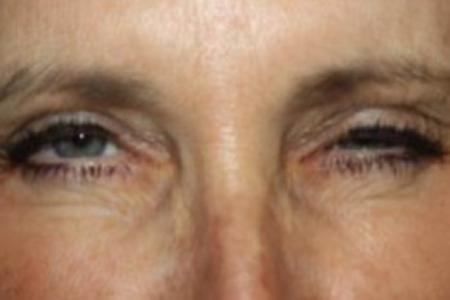After image 1 Case #85301 - Botox (Glabella & Crows Feet) - 54 year old female.