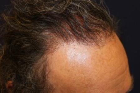 After Case #87381 - Hair Transplantation San Diego