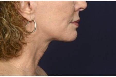 After image 3 Case #86401 - 50 year old woman treated with lower facial rejuvenation