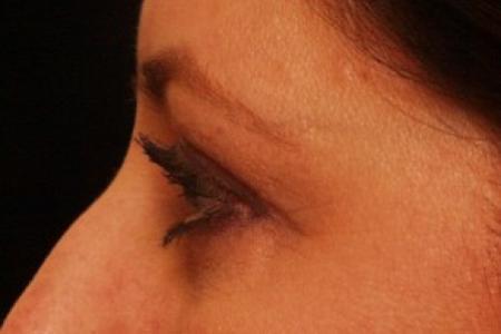 After image 2 Case #81746 - Eyelid Surgery