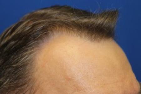 After Case #87391 - Hair Transplantation San Diego