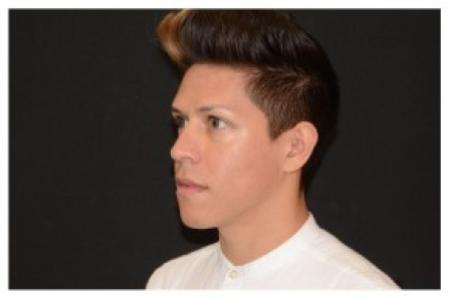 After image 2 Case #87111 - Non-Surgical Rhinoplasty