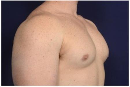 After image 2 Case #86196 - 32 year old man treated with Male Breast Reduction