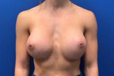 After image 1 Case #88306 - Breast Augmentation on a 27 year old female