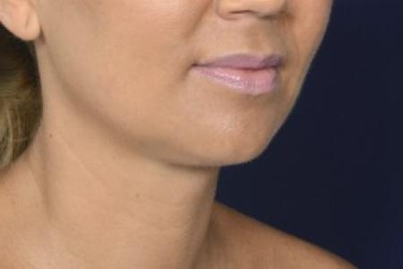 After image 2 Case #87586 - Lower Facial Rejuvenation 