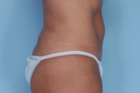 After image 2 Case #82231 - Liposuction