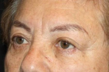 After image 2 Case #84706 - Blepharoplasty and Brow Lift - 78 year old female.