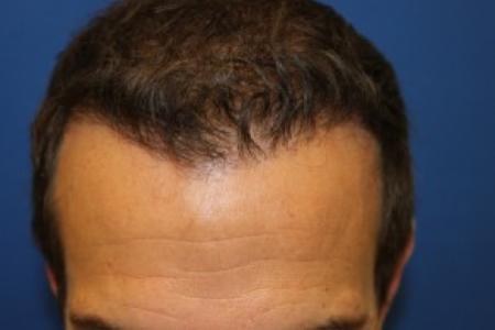 After Case #87396 - Hair Transplantation San Diego