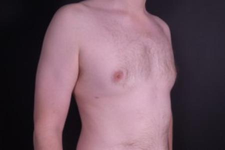 After image 2 Case #85311 - Liposuction Gynecomastia