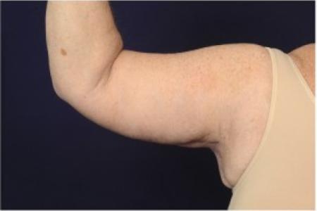 After image 1 Case #87501 - Brachioplasty