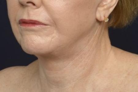 After image 2 Case #87136 - Lower Facial Rejuvenation