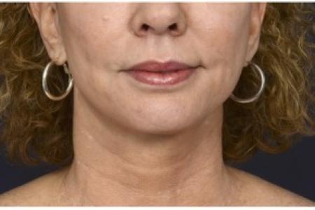 After image 1 Case #86401 - 50 year old woman treated with lower facial rejuvenation