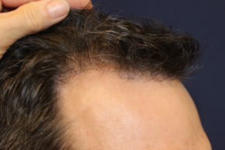 After image 2 Case #87376 - Hair Transplantation San Diego