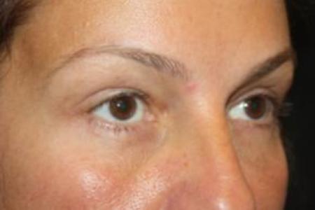 After image 3 Case #85871 - Blepharoplasty and Browlift - 49 year old female