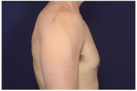 After image 3 Case #86206 - 42 year old man treated with Male Breast Reduction
