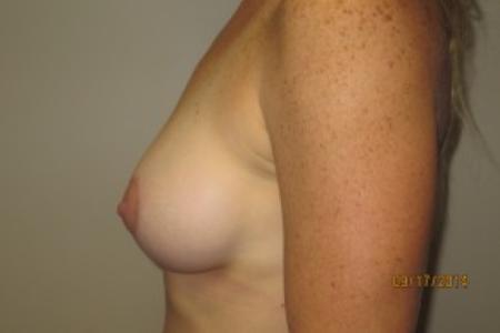 After image 3 Case #82416 - 40 Female Breast Lift