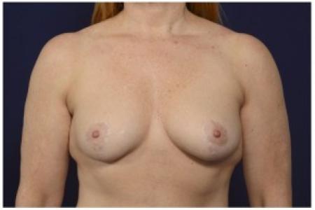 After image 1 Case #86301 - 46 year old woman treated with a Breast Lift