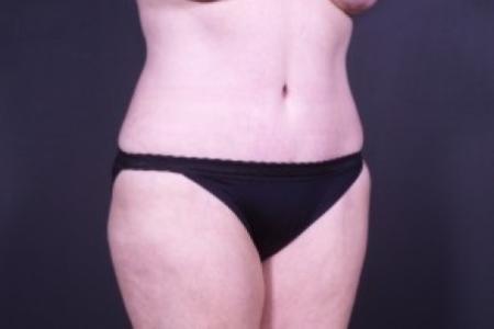 After image 2 Case #83291 - 48 year old patient with Mommy Makeover