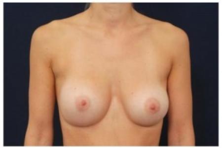 After image 1 Case #81996 - Breast Augmentation