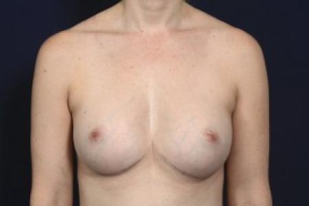 After image 1 Case #87531 - Breast Augmentation Revision