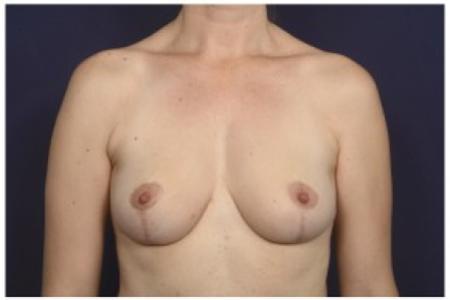 After image 1 Case #84616 - 35-44 year old woman treated with Breast Reduction