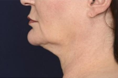 After image 3 Case #87041 - Lower Facial Rejuvenation 