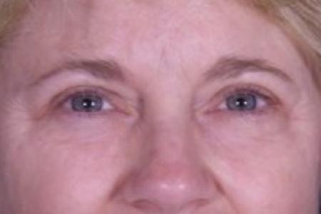 After image 1 Case #84141 - Upper Eyelid Surgery