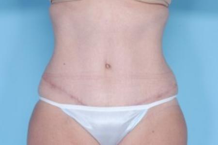 After image 1 Case #82246 - Liposuction