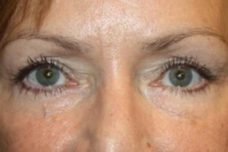 After image 1 Case #83456 - Blepharoplasty - 57 year old female.