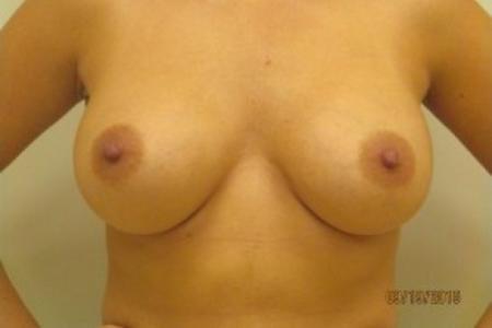 After image 1 Case #82646 - Breast Augmentation (30 year old)