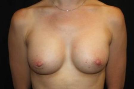 After image 1 Case #84926 - Breast Augmentation - 33 year old female