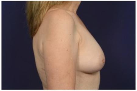 After image 3 Case #84761 - Fat Grafting of Breasts