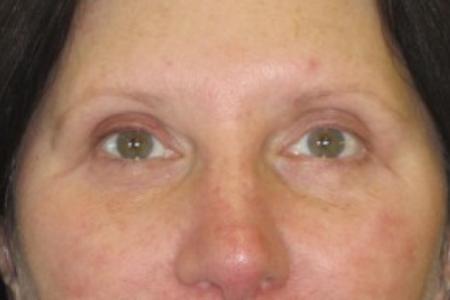 After image 1 Case #82616 - Upper and lower eyelids
