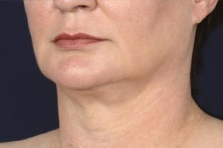 After image 2 Case #87041 - Lower Facial Rejuvenation 