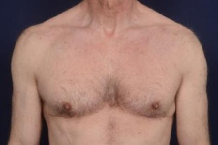 After image 1 Case #87516 - Gynecomastia