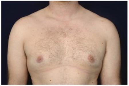 After image 1 Case #85611 - Gynecomastia