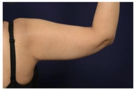 After image 2 Case #87061 - Upper Arm Lift