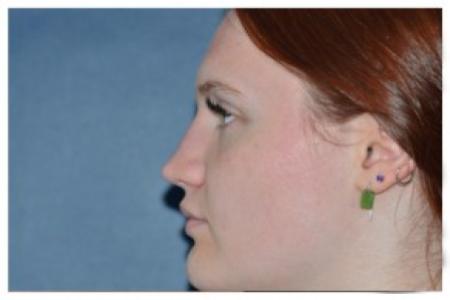 After image 2 Case #87101 - Non-Surgical Rhinoplasty