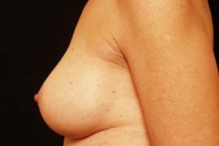 After image 3 Case #81706 - Breast Augmentation