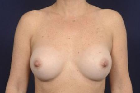 After image 1 Case #87496 - Breast Augmentation